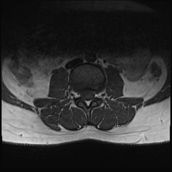 File:Normal lumbar spine MRI- 3 T (Radiopaedia 53280-59250 Axial 9).jpg