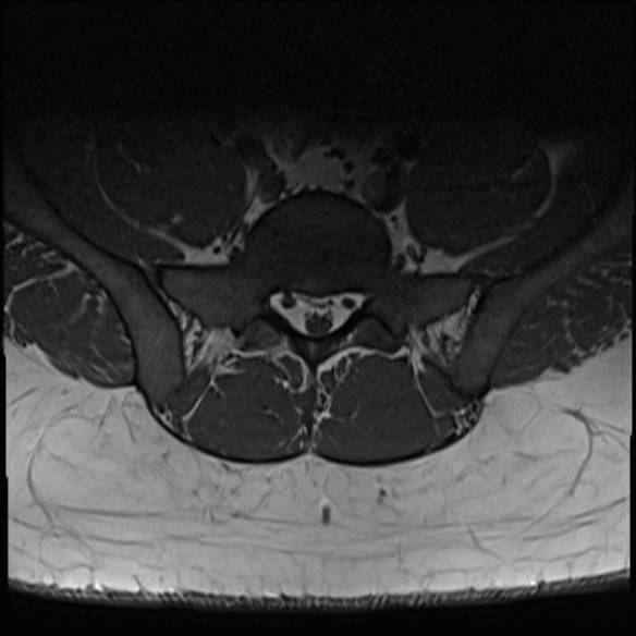 File:Normal lumbar spine MRI (Radiopaedia 47857-52609 Axial T1 29).jpg