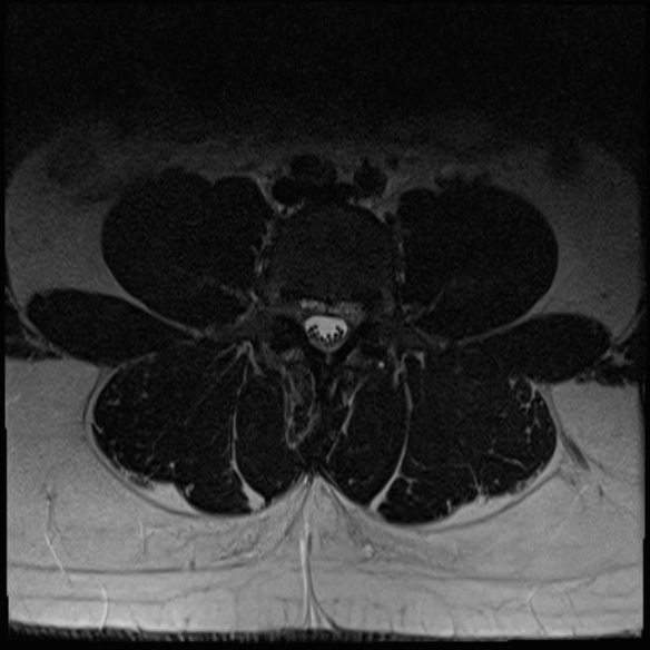 File:Normal lumbar spine MRI (Radiopaedia 47857-52609 Axial T2 13).jpg
