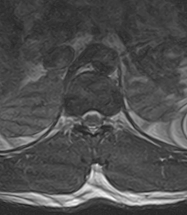 Normal lumbar spine MRI - low-field MRI scanner (Radiopaedia 40976-43699 Axial T2 7).jpg