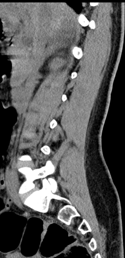Normal lumbosacral CT (Radiopaedia 37923-39867 E 72).png