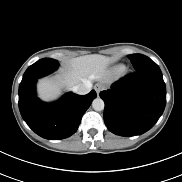 File:Normal multiphase CT liver (Radiopaedia 38026-39996 C 5).jpg