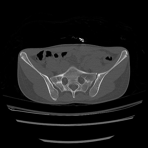Normal pelvis CT (Radiopaedia 51471-57236 Axial bone window 28).jpg