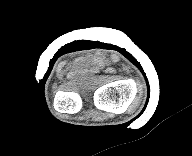 Normal wrist CT (Radiopaedia 41425-44297 Axial non-contrast 42).png