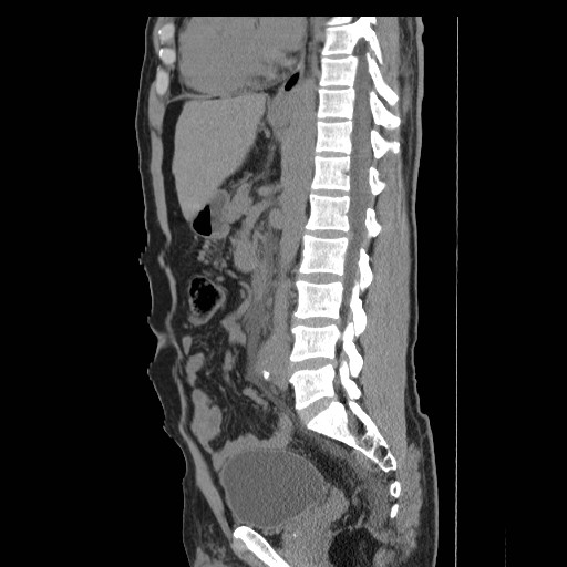 File:Obstructed kidney with perinephric urinoma (Radiopaedia 26889-27066 B 32).jpg