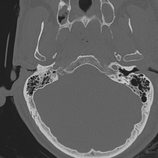 File:Occipital condyle fracture (Radiopaedia 33467-34517 Axial bone window 7).png
