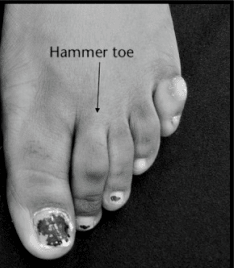 Hammer toe deformity of the left second toe