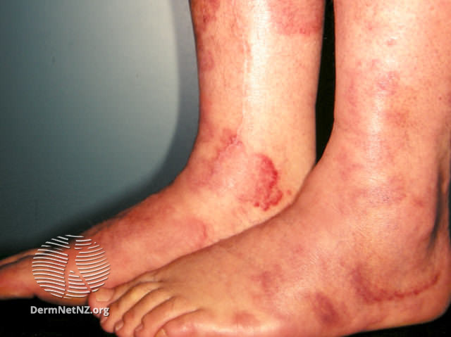 File:Urticarial vasculitis (DermNet NZ doctors-systemic-images-vasc-urt1).jpg