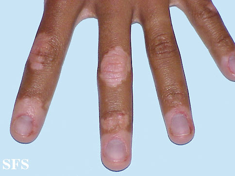 File:Vitiligo (Dermatology Atlas 15).jpg