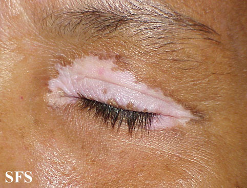 File:Vitiligo (Dermatology Atlas 27).jpg