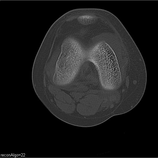 File:ACL avulsion fracture (Radiopaedia 33833-34994 Axial bone window 16).jpg