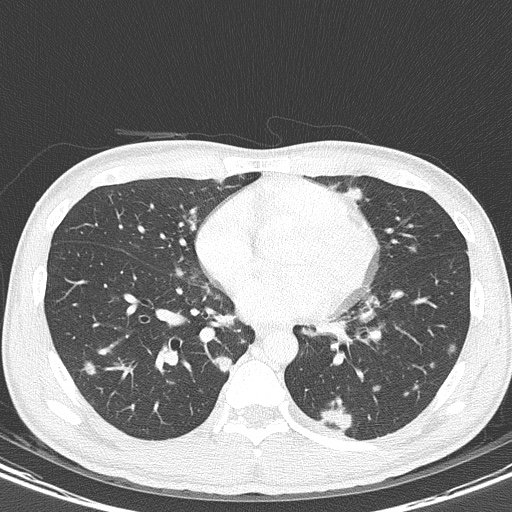 AIDS-related Kaposi sarcoma (Radiopaedia 85247-100811 Axial lung window 105).jpg