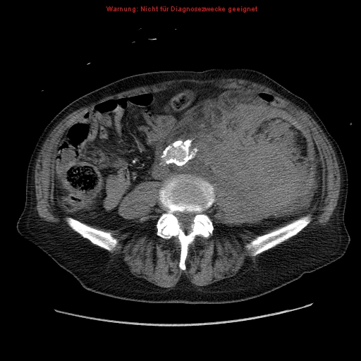 Abdominal aortic aneurysm- extremely large, ruptured (Radiopaedia 19882-19921 Axial C+ arterial phase 46).jpg