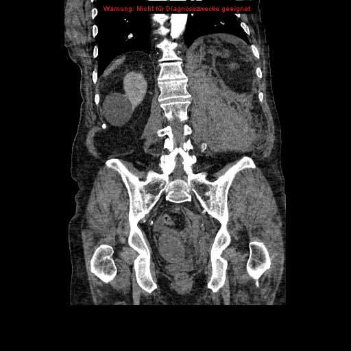 Abdominal aortic aneurysm- extremely large, ruptured (Radiopaedia 19882-19921 Coronal C+ arterial phase 75).jpg