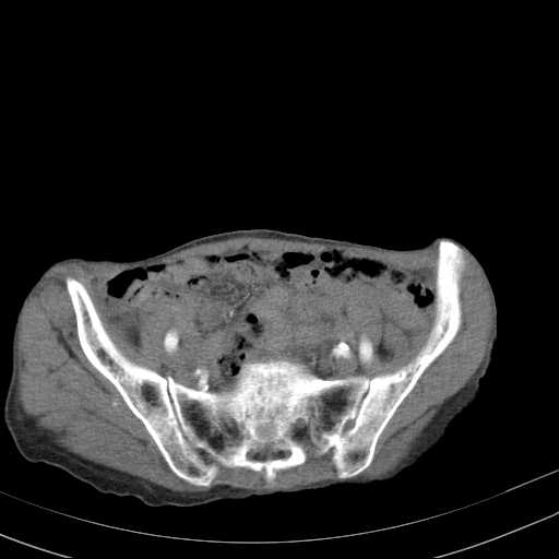 File:Abdominal aortic aneurysm (Radiopaedia 20827-20742 Axial C+ arterial phase 29).jpg