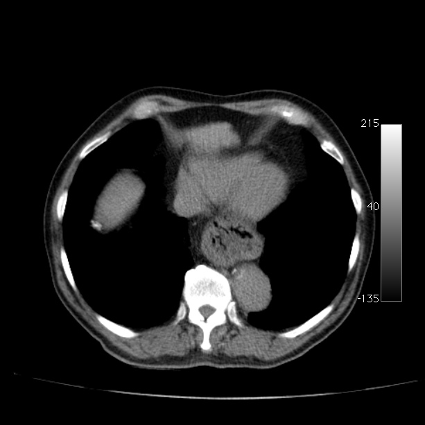 Abdominal aortic aneurysm (Radiopaedia 29248-29660 Axial non-contrast 7).jpg