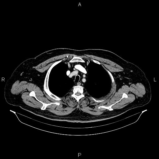 File:Abdominal aortic aneurysm (Radiopaedia 83094-97462 Axial renal cortical phase 15).jpg