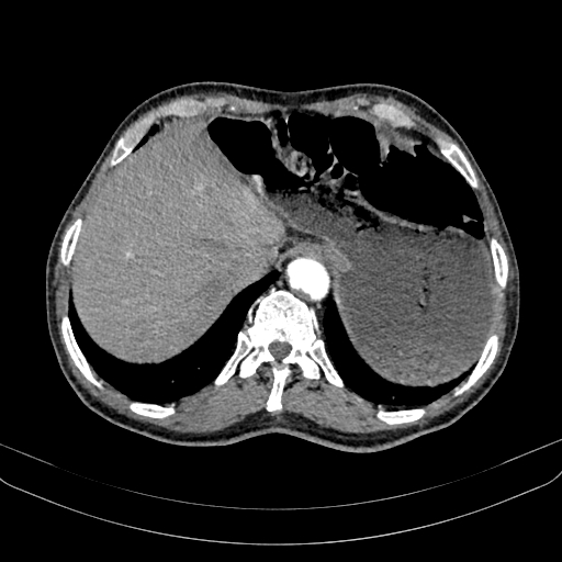 Abdominal aortic aneurysm (Radiopaedia 83581-98689 Axial C+ arterial phase 23).jpg