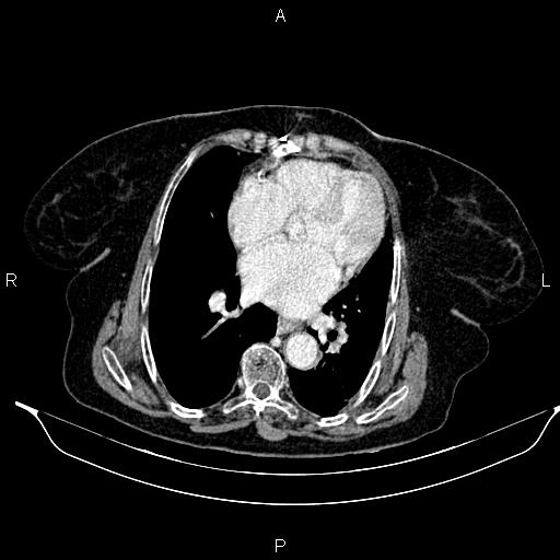 File:Abdominal aortic aneurysm (Radiopaedia 85063-100606 Axial C+ portal venous phase 21).jpg