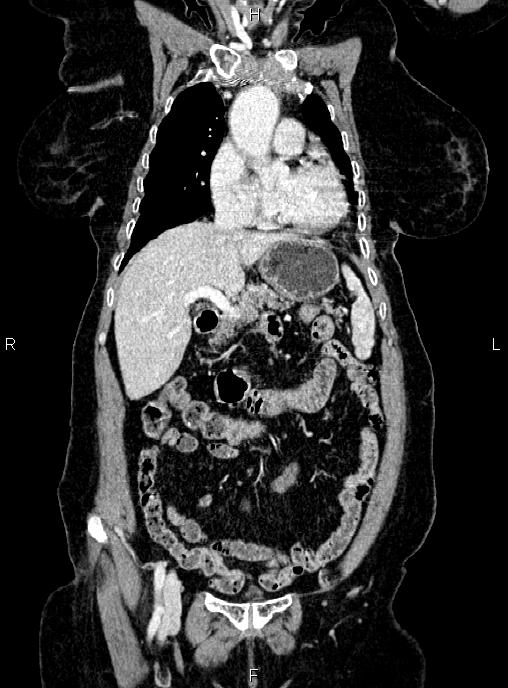 Abdominal aortic aneurysm (Radiopaedia 85063-100606 Coronal C+ arterial phase 16).jpg