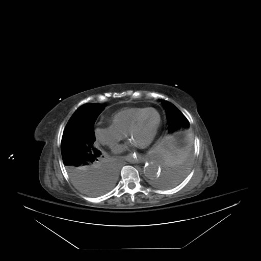 Abdominal aortic aneurysm - impending rupture (Radiopaedia 19233-19247 Axial non-contrast 21).jpg