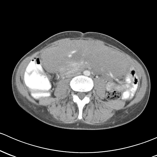 Abdominal desmoid tumor (Radiopaedia 41007-43740 Axial C+ portal venous phase 38).png