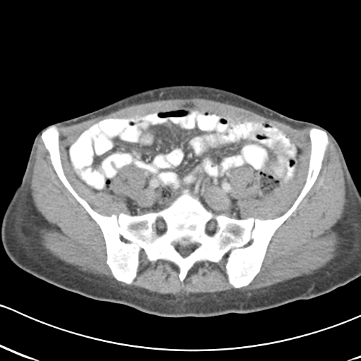 File:Abdominal desmoid tumor (Radiopaedia 41007-43740 Axial C+ portal venous phase 51).png