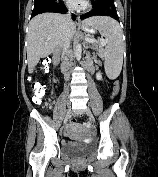 Abdominal lymphoma with sandwich sign (Radiopaedia 84378-99704 Coronal C+ portal venous phase 36).jpg