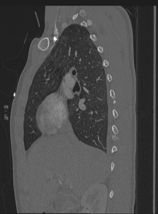 Abdominal multi-trauma - devascularised kidney and liver, spleen and pancreatic lacerations (Radiopaedia 34984-36486 Sagittal bone window 55).png