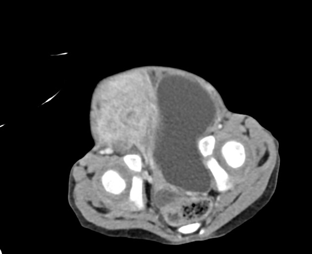 Abdominopelvic rhabdomyosarcoma (Radiopaedia 78356-90984 Axial C+ portal venous phase 144).jpg