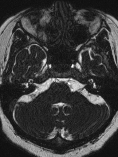 Abducens nerve palsy (Radiopaedia 57084-63976 Axial T2 ciss 3d 23).jpg