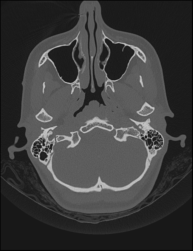 Aberrant right internal carotid artery (Radiopaedia 65191-74198 Axial non-contrast 20).jpg