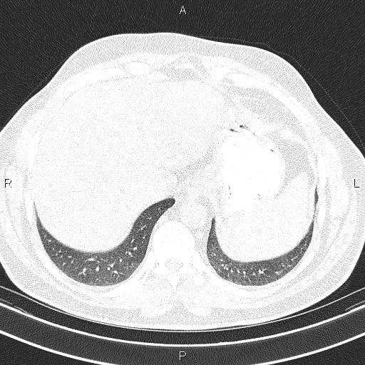 Aberrant right subclavian artery (Radiopaedia 87093-103354 Axial lung window 94).jpg