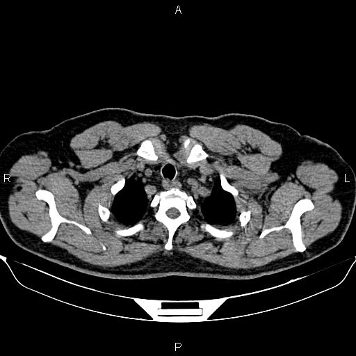Aberrant right subclavian artery (Radiopaedia 87093-103354 Axial non-contrast 12).jpg