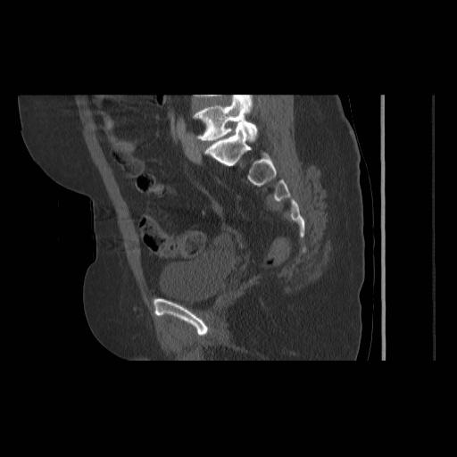 File:Acetabular fracture (Radiopaedia 13193-13212 Sagittal bone window 40).jpg