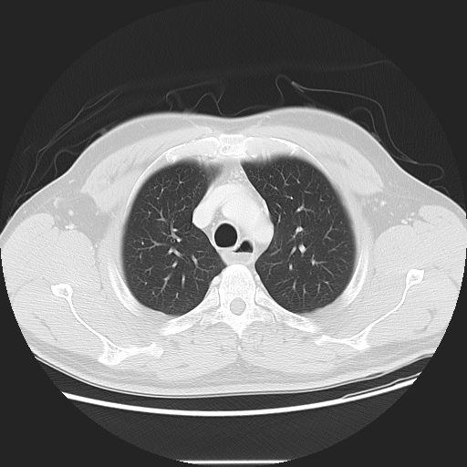 Achalasia (Radiopaedia 8831-9629 Axial lung window 18).jpg