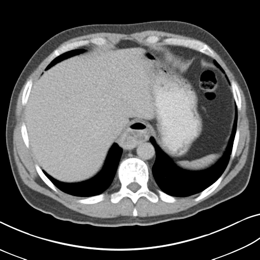 File:Achalasia of the cardia (Radiopaedia 38497-40595 Axial C+ portal venous phase 14).png