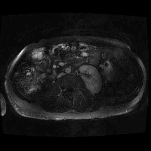 Acinar cell carcinoma of the pancreas (Radiopaedia 75442-86668 Axial T1 C+ fat sat 13).jpg