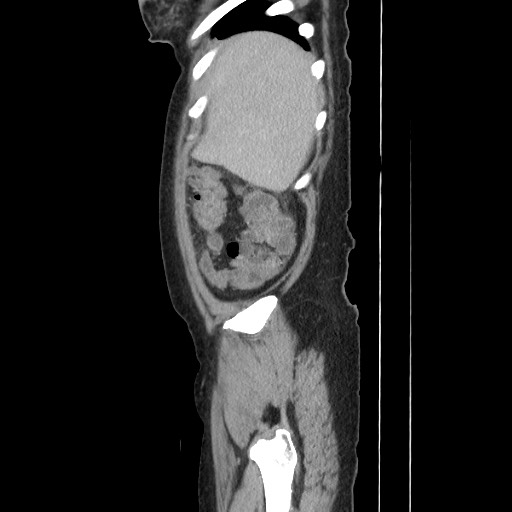 Acinar cell carcinoma of the pancreas (Radiopaedia 75442-86669 Sagittal C+ portal venous phase 38).jpg