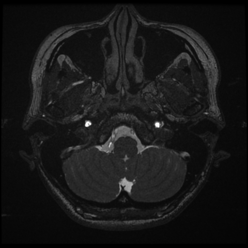 File:Acoustic neuroma (Radiopaedia 34049-35283 Axial 16).png