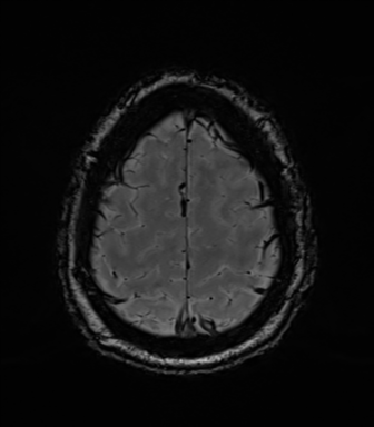 Acoustic schwannoma (Radiopaedia 50846-56358 Axial SWI 81).png