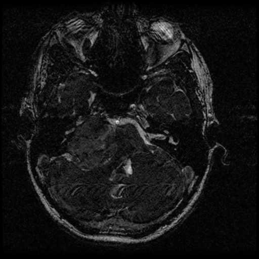 Acoustic schwannoma - eroding petrous apex (Radiopaedia 39674-42004 Axial T2 35).png