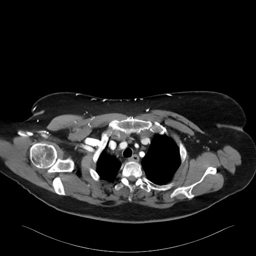 Acromioclavicular joint cyst (Radiopaedia 58455-65610 Axial C+ arterial phase 29).jpg