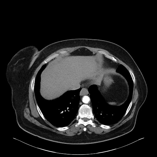 Acromioclavicular joint cyst (Radiopaedia 58455-65610 Axial C+ arterial phase 81).jpg