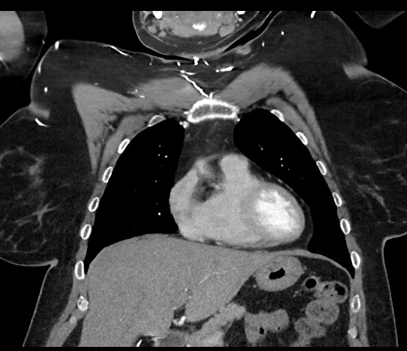 Acromioclavicular joint cyst (Radiopaedia 58455-65610 Coronal C+ arterial phase 52).jpg