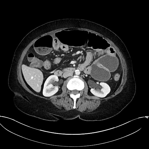Active Crohn disease (Radiopaedia 59394-66750 Axial C+ portal venous phase 33).jpg