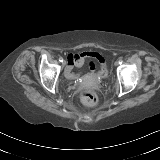File:Active bleeding from duodenal ulcer with embolization (Radiopaedia 34216-35481 Axial non-contrast 61).png