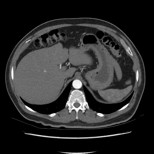 Active colonic bleed on CT (Radiopaedia 49765-55025 Axial C+ arterial phase 19).jpg