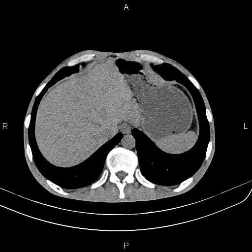 File:Active crohn disease (Radiopaedia 87133-103397 Axial non-contrast 13).jpg