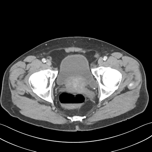 File:Active diverticular hemorrhage (Radiopaedia 39415-41725 Axial C+ portal venous phase 66).png